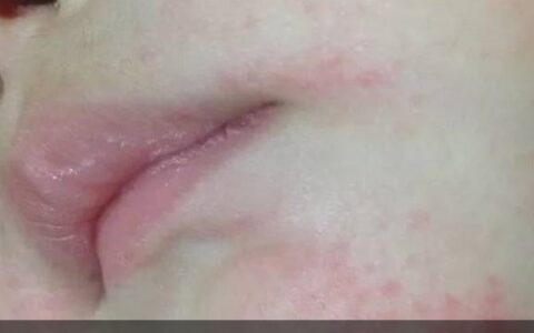 宝宝的口水疹要怎么护理才有效？-宝宝口水疹特别严重怎么办