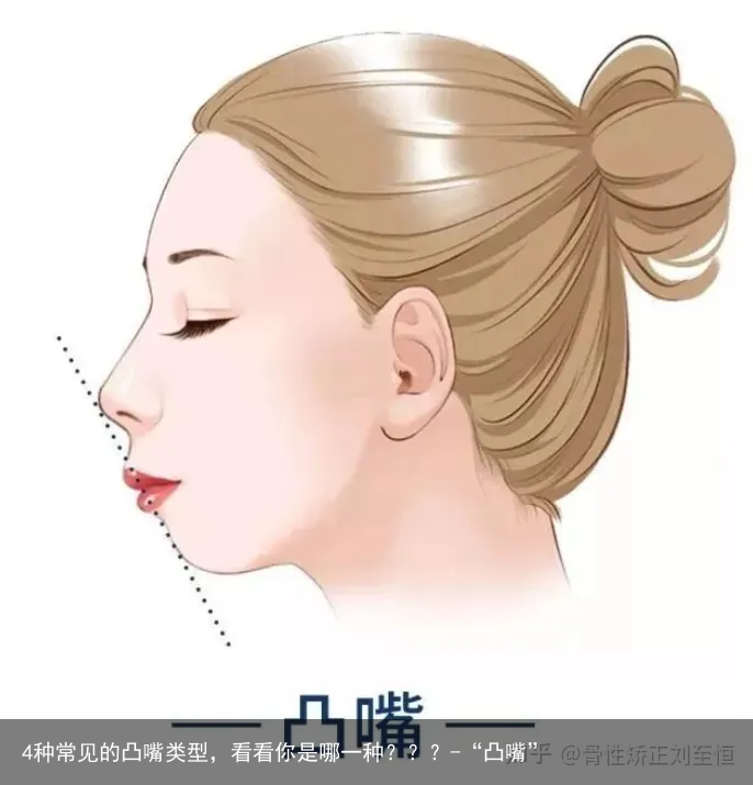 4种常见的凸嘴类型,看看你是哪一种???-“凸嘴” - 怎通