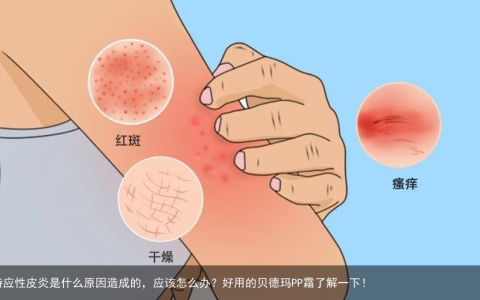 特应性皮炎是什么原因造成的，应该怎么办？好用的贝德玛PP霜了解一下！