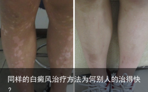 同样的白癜风治疗方法为何别人的治得快？