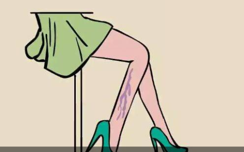 静脉曲张真正的治疗方法，快来了解！(静脉曲张微创哪家医院好)