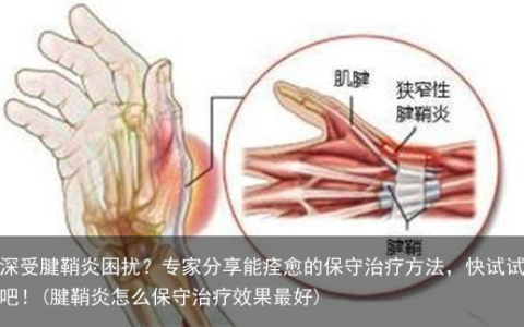 深受腱鞘炎困扰？专家分享能痊愈的保守治疗方法，快试试吧！(腱鞘炎怎么保守治疗效果最好)
