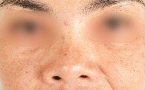 脸上长斑，要怎么淡化？来看看别人是怎么做的吧-脸上长斑怎么搞