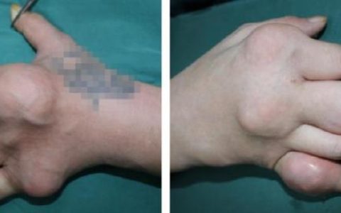 世界痛风日｜26岁小伙子，全身都是通风石，最大的如鸡蛋，原因是……