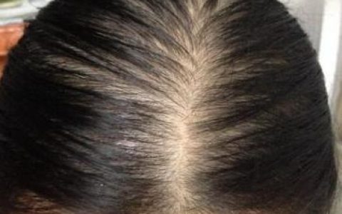 女性头顶稀疏怎么办？究竟是什么原因引起的呢？-女性头顶稀疏怎么办?究竟是什么原因引起的呢怎么治疗
