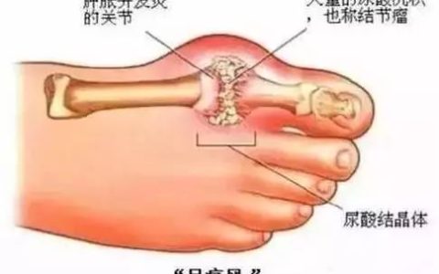 痛风的一个小方子，一点也不难喝，太棒了！-治疗痛风偏方秘方大全