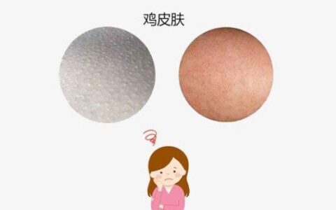 鸡皮肤怎么消除最有效 实用快捷的方法全在这-鸡皮肤怎么消除最有效 只需这几步