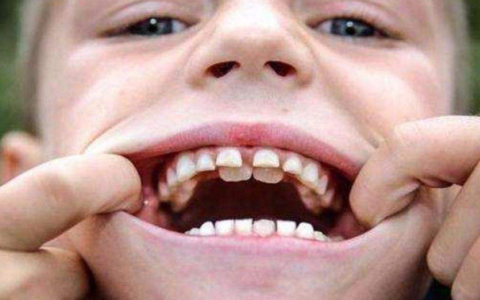 10个孩子5个是双排牙，这是怎么回事呢？可能都是父母的错-孩子有双排牙怎么矫正视频教程