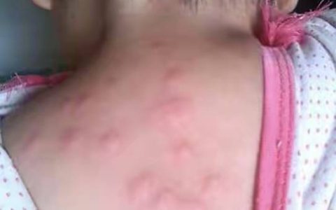 很多家长认为孩子长大后过敏就会自然好转，真的是这样吗？（过敏性紫癜小时候治好长大还会再犯吗）