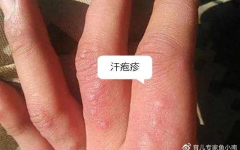 夏天宝宝手上长的小水泡是什么？这还是宝宝的手吗？要紧不？-夏天宝宝手上长小水泡怎么回事