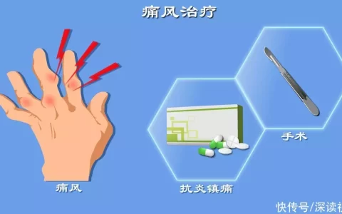 痛风没得治？抗炎镇痛降尿酸？手术取石？痛风治疗门道多，全解读黄老师为何会爆火？肤白貌美颜值高，看到她的素颜照后，我沉默了-治疗痛风的手术
