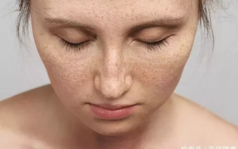 脸上长斑，或与这4个诱发因素有关，要避开，才能有效预防斑点