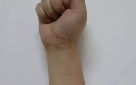 肌肤瘙痒难耐，可能是慢性湿疹所致，3类致病因素要当心