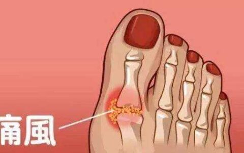 判断有没有痛风，并不是看尿酸的高低，教你正确的方法-怎么判断有没有痛风呢