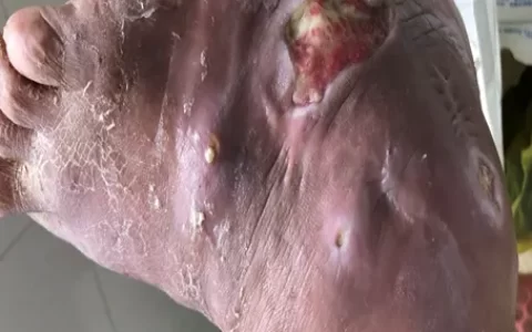 用什么方法可以检测痛风？-如何检测痛风