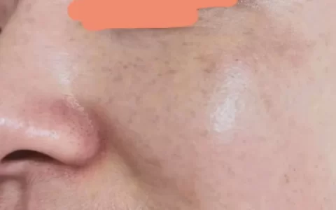 脸上密密麻麻的斑到底该怎么消下去？-脸上密密麻麻的斑到底该怎么消下去图片大全