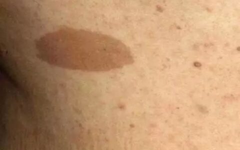 儿童最常见的皮疹照片合集，胆小勿入！-儿童皮疹常见原因分析