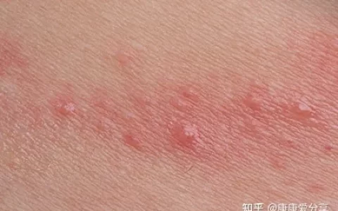 身上起红疙瘩，越挠越痒可能是这9种皮肤病