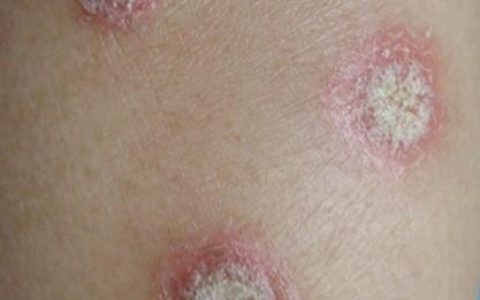 牛皮癣的四种类型图片