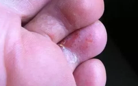 5种真菌性皮肤病图谱及诊疗建议-真菌性皮肤病都有哪些