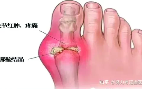 如何判断自己已经患上痛风？-如何判断自己已经患上痛风了图片