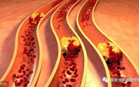 甘油三酯高，餐桌上2种食物是降脂高手，每天吃一点血脂降得快