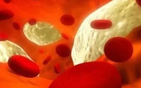 甘油三酯越高，血管堵塞越严重，3个技巧能快速降血脂通血管