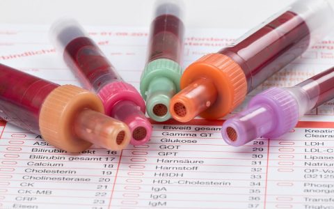 血脂高，别急着吃药！为你总结：5个方法降血脂，不用吃药也能降