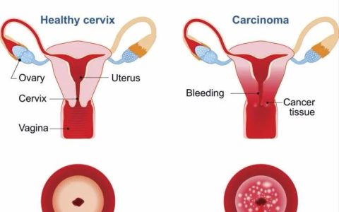看完了你就知道什么是宫颈癌前变-啥是宫颈癌前病变
