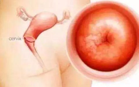宫颈的低级和高级鳞状上皮内病变的区别-高级别鳞状上皮内低度病变什么意思