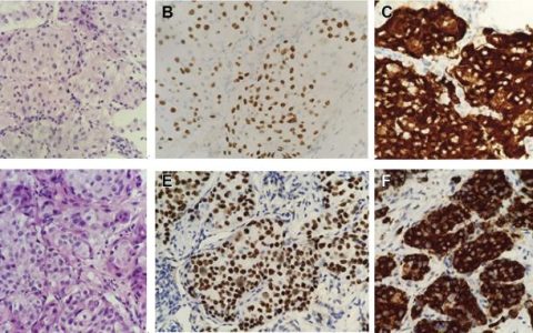 克唑替尼治疗ALK和ROS1双重排肺鳞状细胞癌病例报告-克唑替尼的功效与副作用