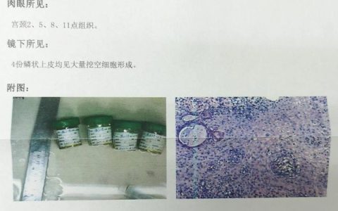 如果查出HPV阳性须警惕！-检查出来hpv阳性可以打四价吗