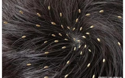 为何小时候大多数人都会长的“虱子”，现在都不见了？今天知道了-为什么小时候头上长虱子长大了不长