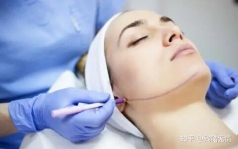 深度科普：筋膜悬吊提升术是什么、筋膜提拉一般多少钱~-筋膜悬吊是拉皮吗