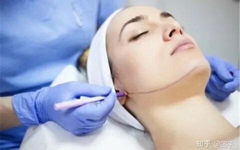 调查：筋膜悬吊面部提升术保持多久？筋膜提拉一般多少钱-筋膜悬吊术是拉皮吗