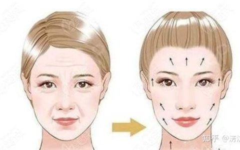 筋膜提升术是什么？闺蜜问：筋膜提升多少钱？-目前最安全的面部提升手术