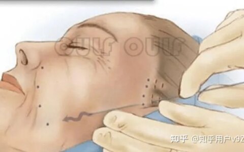 筋膜提拉术手术全过程，筋膜提升恢复期多长时间~-筋膜提拉术到底好不好