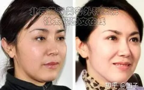 筋膜悬吊面部提升术后悔死了？筋膜悬吊面部提升术原理-无痕筋膜提升术多少钱