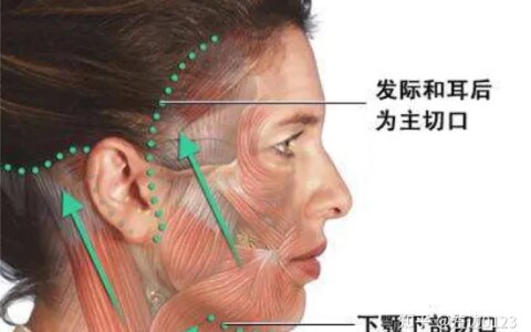筋膜悬吊术、筋膜悬吊提升术是什么-筋膜悬吊术,筋膜悬吊提升术是什么手术