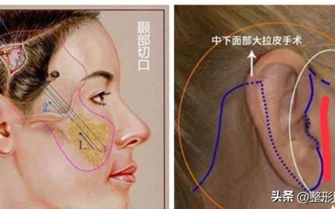 总结了最近准备做拉皮手术的求美者咨询的最多的8个问题-拉皮手术费用是多少