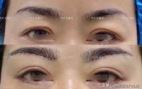 筋膜悬吊提眉手术所能达到的6个效果，准备提眉手术的姐妹了解下-筋膜悬吊提眉术视频