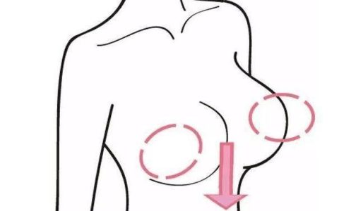 乳房提升手术怎么做？手术需要多少钱？-乳房提升手术后的注意事项