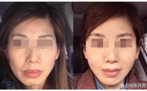 小拉皮提升反馈，恢复34天素颜，术前术后状态对比分析-做小拉皮手术视频