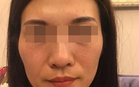 拉皮术后37天、70天，模样大不一样，从面诊到手术过程分享-拉皮术后的效果是最终效果吗