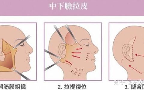 做完筋膜提升后悔了 筋膜提升的损伤太吓人了-有做过筋膜提升手术的吗?