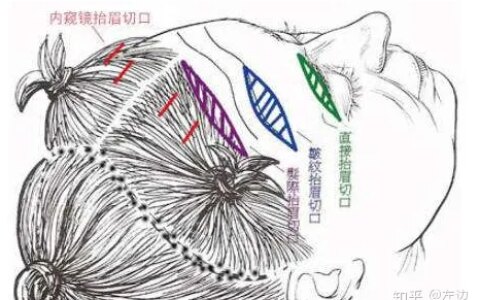 面部筋膜提升 筋膜悬吊面部提升术的效果想年轻过来看看-筋膜悬吊术治疗面瘫