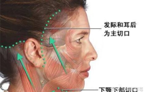 筋膜提升术、面部筋膜提升术能保持多久-面部松弛下垂提升最有效的方法