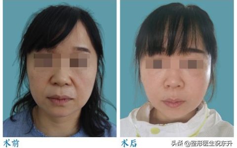 没搞清楚这25个问题，先别做”面部五层提升手术”-5d全脸提升为什么保持时间久