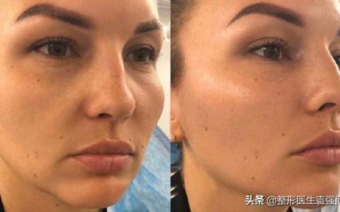 35岁后面部松弛，医生说这4种提升方式还不错-35岁下垂松弛的脸怎么办