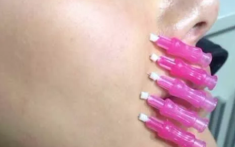 为什么有人做完筋膜提升后悔了，这些bug你有中吗？-筋膜提升有什么后遗症